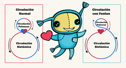 Cirugías en las Cardipatías Congénitas Complejas